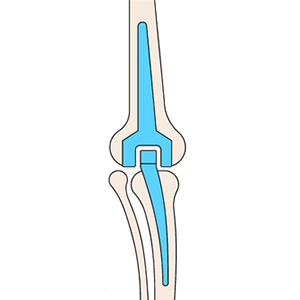 diagram showing elbow replacement.