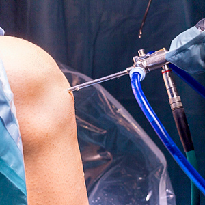 Closeup of knee arthroscopy micro-surgery