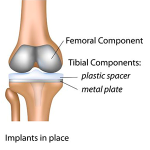 diagram of knee showing implants in place