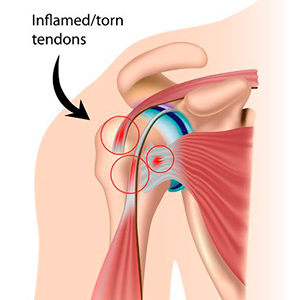 diagram showing the shoulder with inflamed/torn tendons