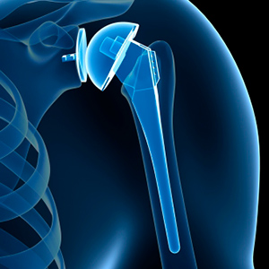 3d illustration of shoulder replacement